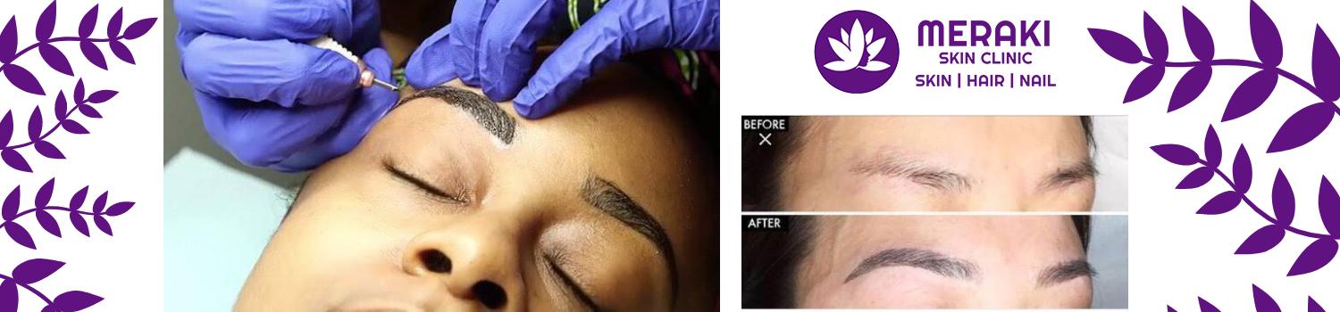 Best Microblading Treatment in Gurgaon, Online Acne consultation