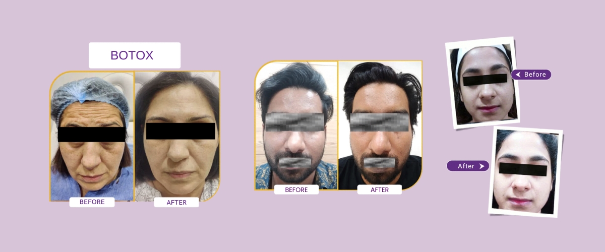 Anti Aging Treatment at Meraki Skin Clinic Gurgaon