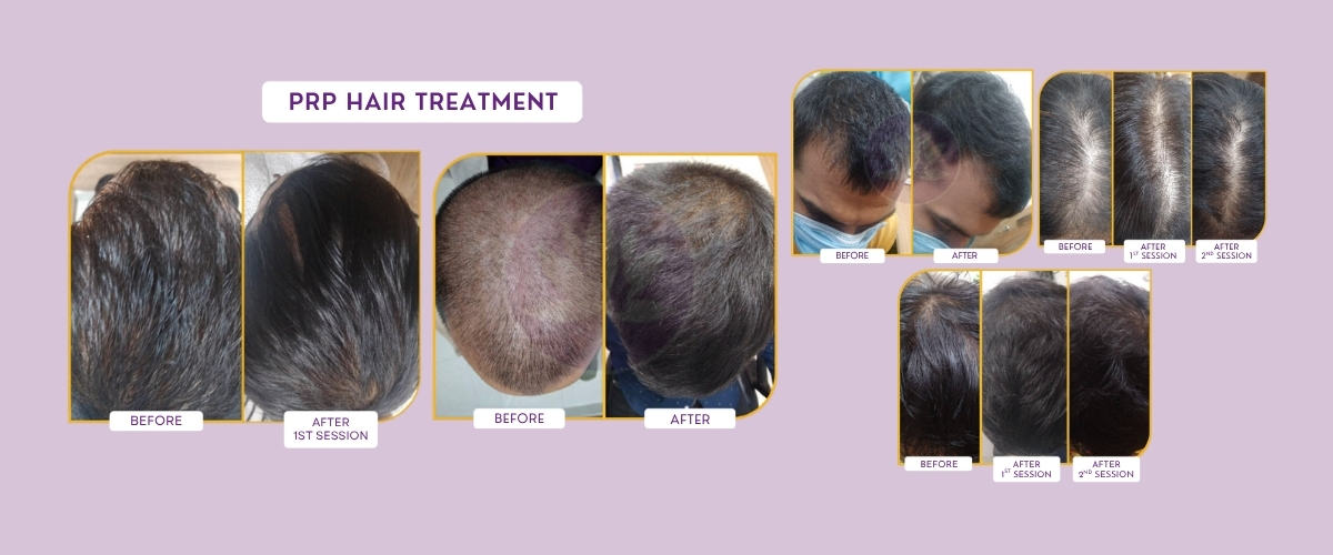 Hair Fall Treatment at Meraki Skin Clinic Gurgaon