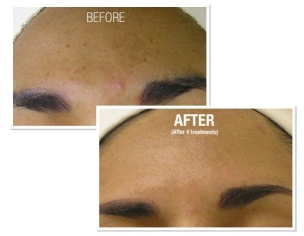 Hydrafacials Before After