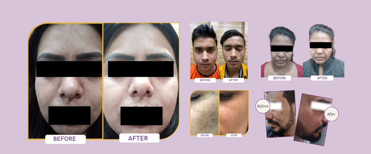 Acne and Pimple Treatment at Meraki Skin Clinic Gurgaon
