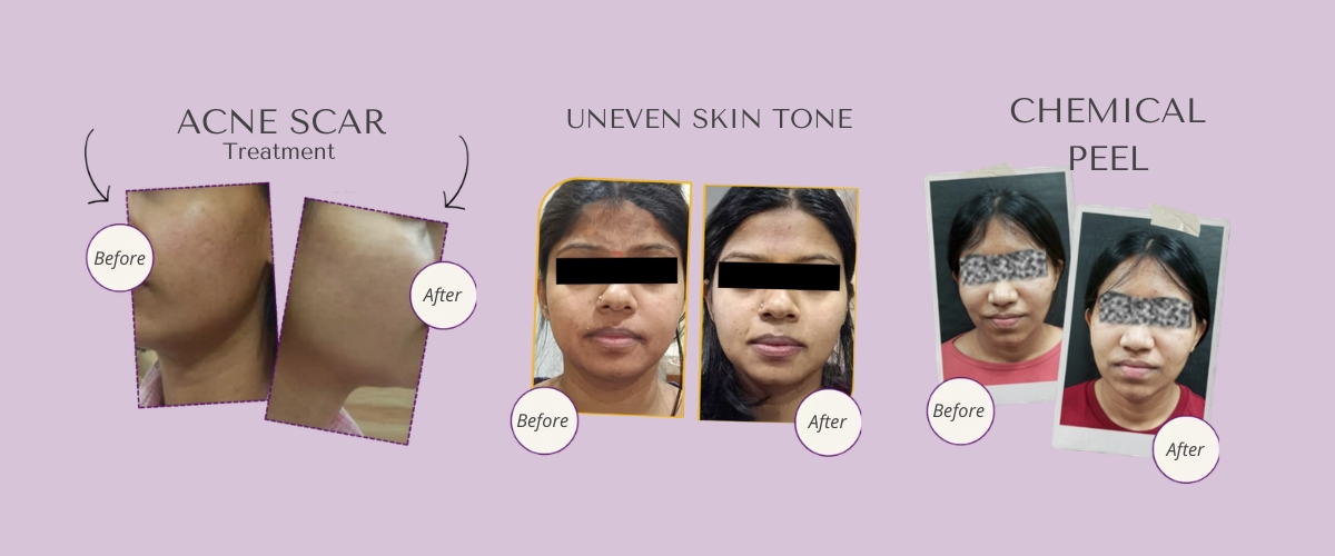 Pigmentation and Tan Removal Treatment at Meraki Skin Clinic Gurgaon