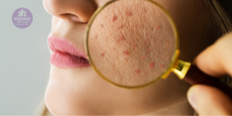 Acne Management