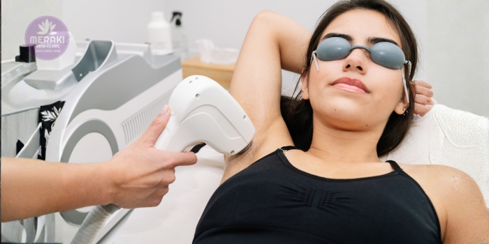 Laser Hair Removal