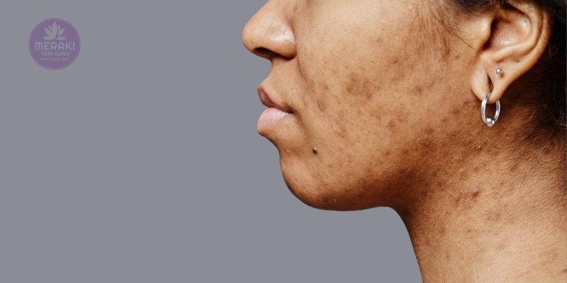 Pigmentation Management