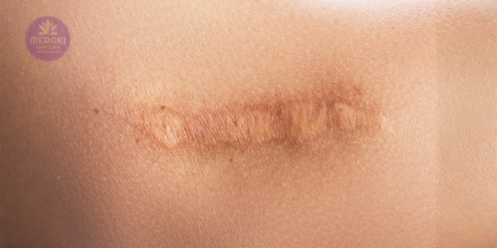 Scar Reduction